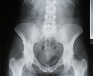 Pelvic X-Ray